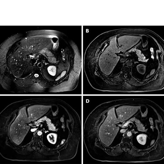 MRI Whole Abdomen Pancreas